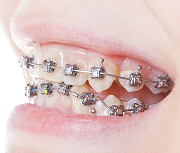 Orthodontics and Myofunctional Therapy