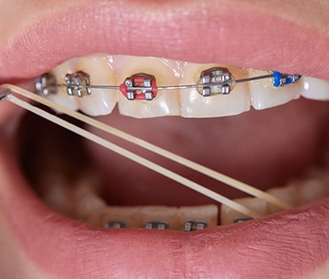 Temporomandibular Joint (TMJ) Treatment