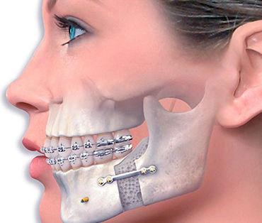 Jaw Surgery