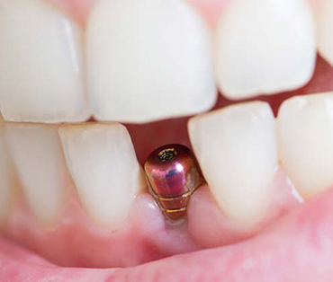 Single Tooth Implant