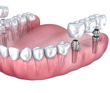 Dental Bridge