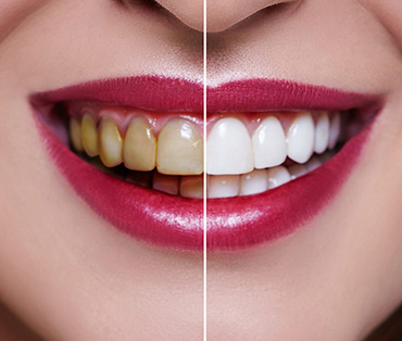 Tooth whitening