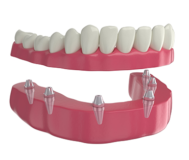 Dental implants